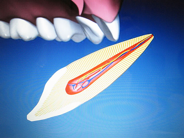 Zahnunfall - Zahn ausgeschlagen